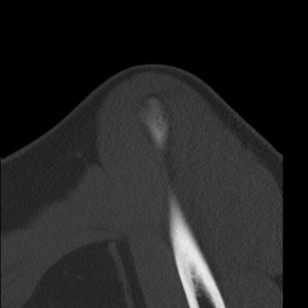 File:Bankart lesion (Radiopaedia 22771-22798 Sagittal bone window 2).jpg