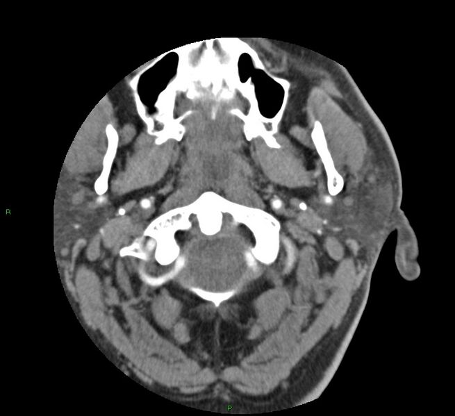 File:Basal ganglia hemorrhage (Radiopaedia 58763-65985 D 5).jpg