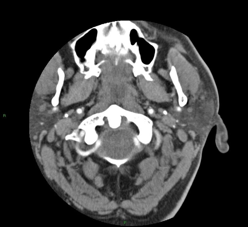 Basal ganglia hemorrhage (Radiopaedia 58763-65985 D 5).jpg