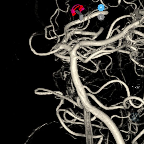 File:Basilar artery perforator aneurysm (Radiopaedia 82455-97734 3D view left VA 32).jpg
