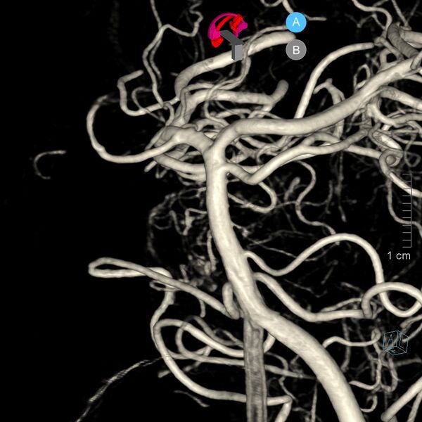 File:Basilar artery perforator aneurysm (Radiopaedia 82455-97734 3D view left VA 33).jpg