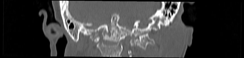Basilar impression (Radiopaedia 52411-58522 Coronal bone window 112).jpg
