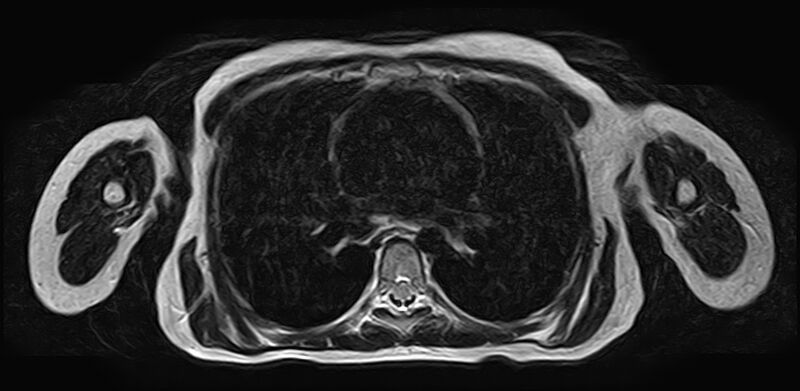 File:Bilateral Sprengel deformity with Klippel-Feil syndrome (Radiopaedia 66395-75650 Axial T2 31).jpg