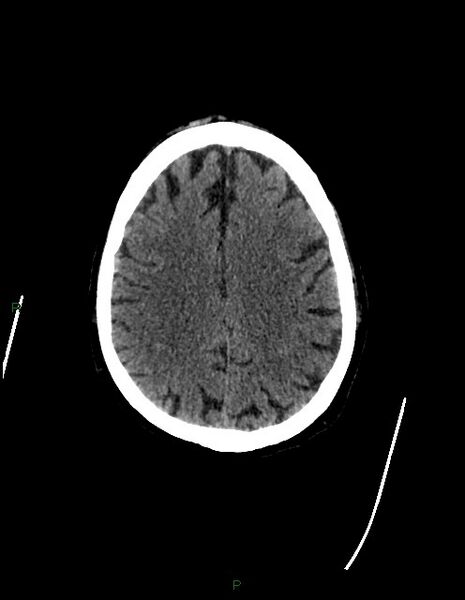 File:Bilateral acute middle cerebral artery territory infarcts (Radiopaedia 77319-89401 Axial non-contrast 62).jpg