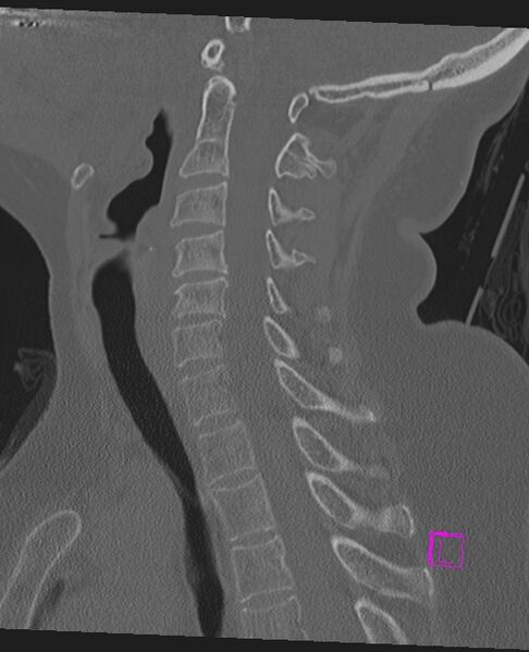 File:Bilateral atlanto-occipital assimilation (Radiopaedia 28350-28603 Sagittal bone window 43).jpg