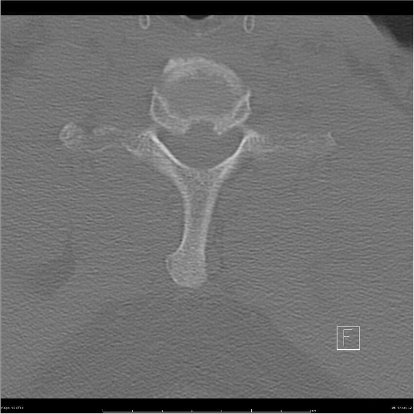 Bilateral cervical ribs (Radiopaedia 25868-26017 Axial bone window 41).jpg