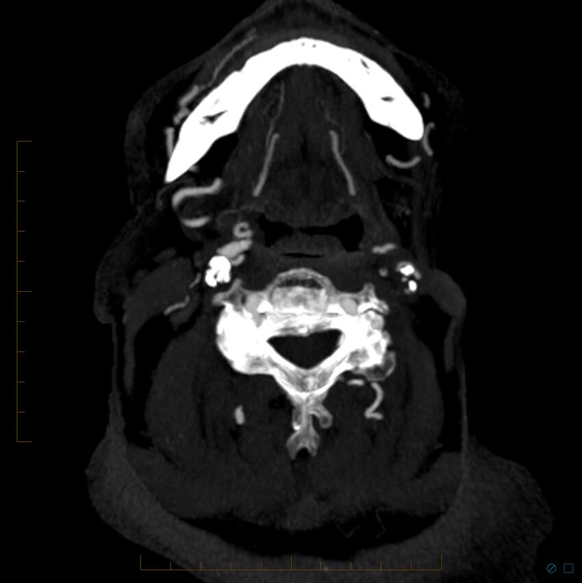 Bilateral chronic common carotid occlusion (Radiopaedia 50849-56362 D 38).jpg