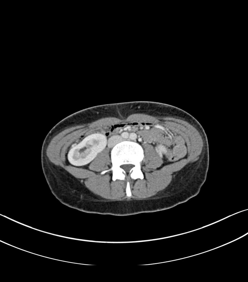 Bilateral kidney malrotation (Radiopaedia 72227-82749 A 37).jpg
