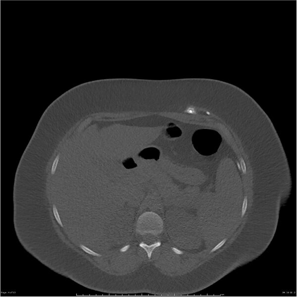 File:Bilateral lumbar ribs (Radiopaedia 25862-26010 bone window 4).jpg