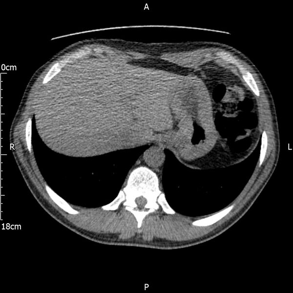 File:Bilateral medullary nephrocalcinosis with ureteric calculi (Radiopaedia 71269-81569 Axial non-contrast 8).jpg