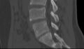 Bilateral pars defect (Radiopaedia 26691-26846 Sagittal bone window 36).jpg