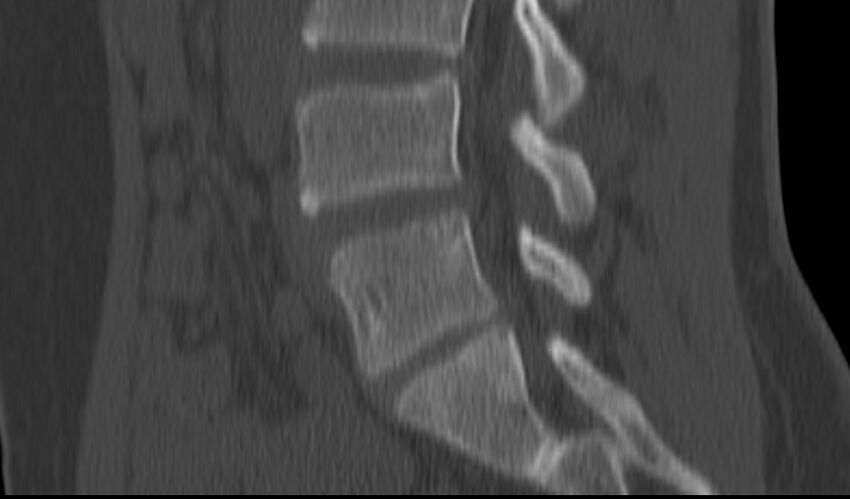 Bilateral pars defect (Radiopaedia 26691-26846 Sagittal bone window 36).jpg