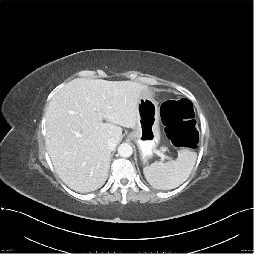 Bilateral psoas hematomas (Radiopaedia 24057-24279 A 17).jpg