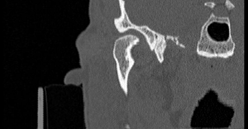 Bilateral temporal bone fractures (Radiopaedia 29482-29970 Coronal non-contrast 46).jpg