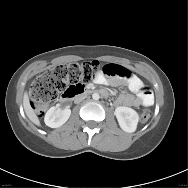 File:Bilateral ureteritis and cystitis (Radiopaedia 25340-25594 A 31).jpg