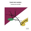 Biliary duct anatomic variation (diagram) (Radiopaedia 70380-80479 Cystic duct 8).jpeg