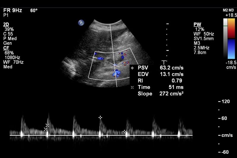 File:Biliary necrosis - liver transplant (Radiopaedia 21876-21843 A 12).jpg