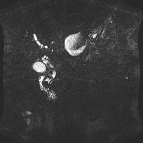 File:Biliary pancreatitis (Radiopaedia 72289-82824 Coronal 3D T2 56).jpg