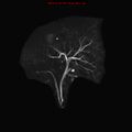 Biliary tree anatomical variant - biliary trifurcation (Radiopaedia 12531-12750 Coronal 3D MRCP 20).jpg