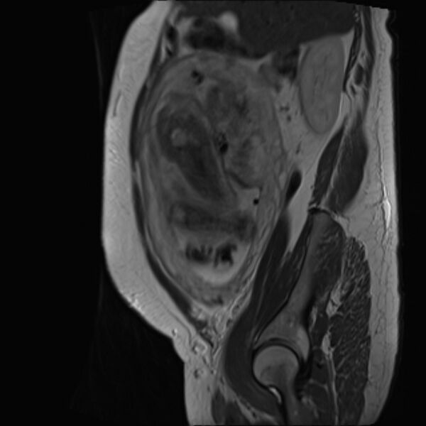 File:Bilobed placenta accreta (Radiopaedia 69648-79591 Sagittal T2 31).jpg