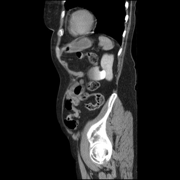 File:Bladder tumor detected on trauma CT (Radiopaedia 51809-57609 E 16).jpg