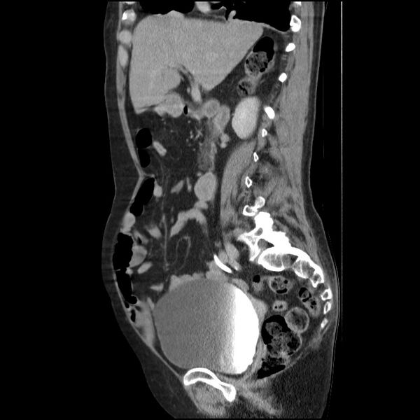 File:Bladder tumor detected on trauma CT (Radiopaedia 51809-57609 E 44).jpg