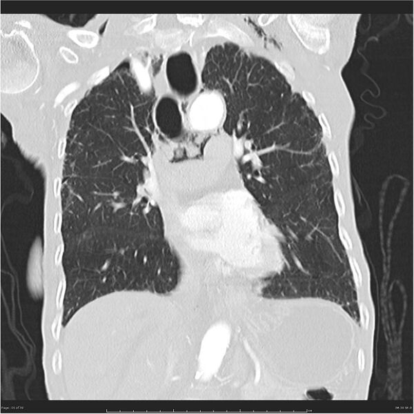 File:Boerhaave syndrome (Radiopaedia 26240-26362 Coronal lung window 15).jpg