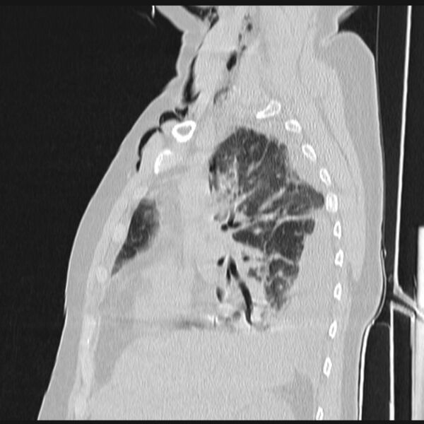 File:Boerhaave syndrome (Radiopaedia 45644-49799 Sagittal lung window 27).jpg