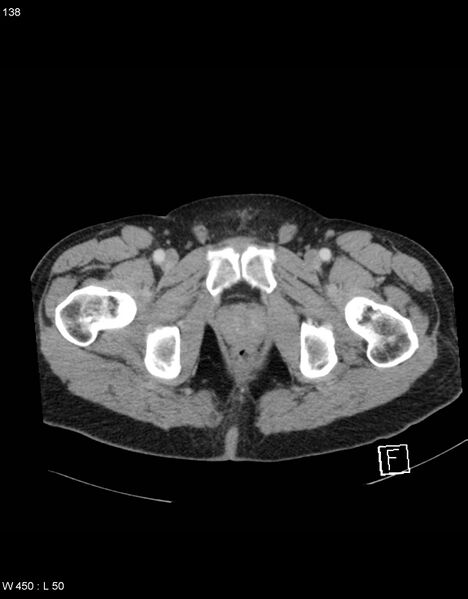 File:Boerhaave syndrome with tension pneumothorax (Radiopaedia 56794-63603 A 69).jpg