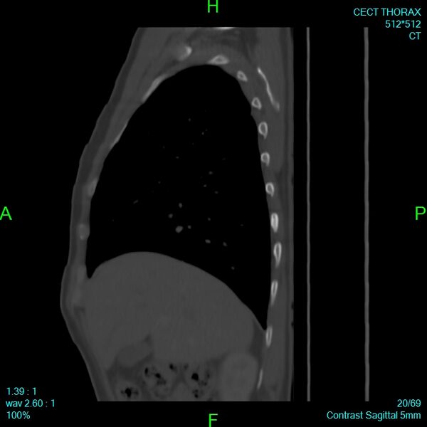 File:Bone metastases from lung carcinoma (Radiopaedia 54703-60937 Sagittal bone window 20).jpg