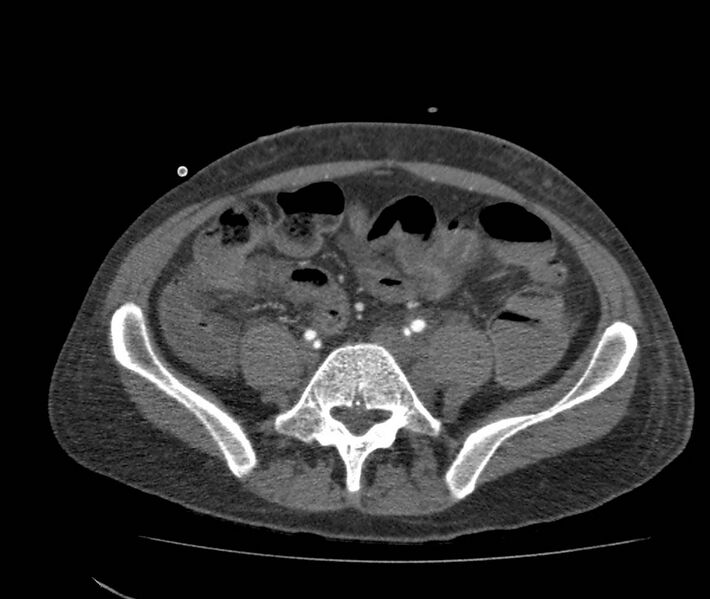 File:Bowel lymphoma complicated by bleeding after therapy (Radiopaedia 55601-62110 B 56).jpg