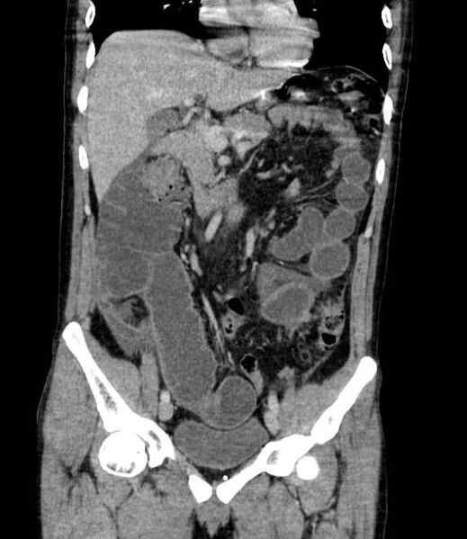 File:Bowel obstruction from colon carcinoma (Radiopaedia 22995-23028 C 32).jpg