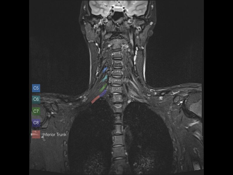 File:Brachial plexus anatomy (Radiopaedia 64414-73226 Coronal STIR 7).jpeg