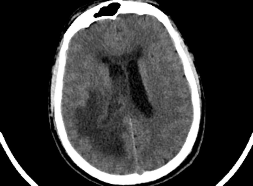 Brain abscess complicated by intraventricular rupture and ventriculitis (Radiopaedia 82434-96575 Axial non-contrast 65).jpg