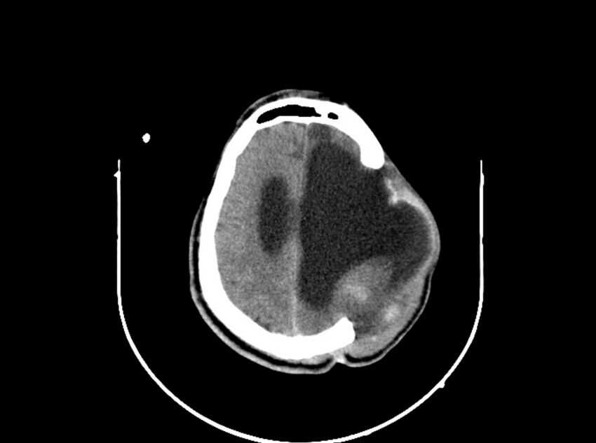 Brain injury by firearm projectile (Radiopaedia 82068-96088 A 159).jpg