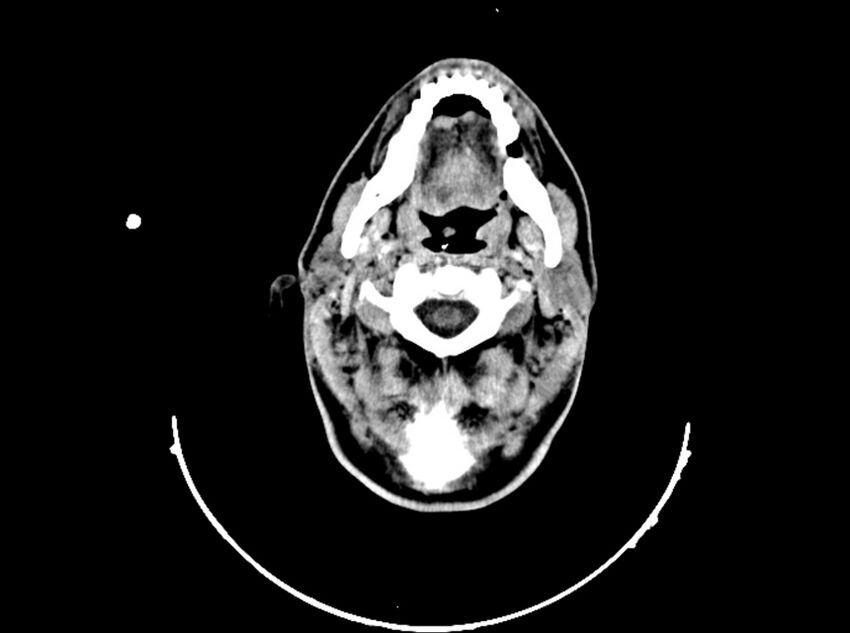 Brain injury by firearm projectile (Radiopaedia 82068-96088 A 51).jpg