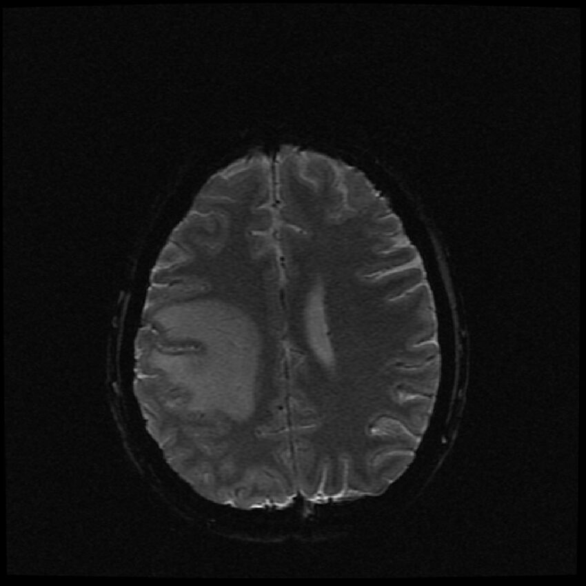 Brain metastases (renal cell carcinoma) (Radiopaedia 42571-45704 Axial SWI 17).jpg