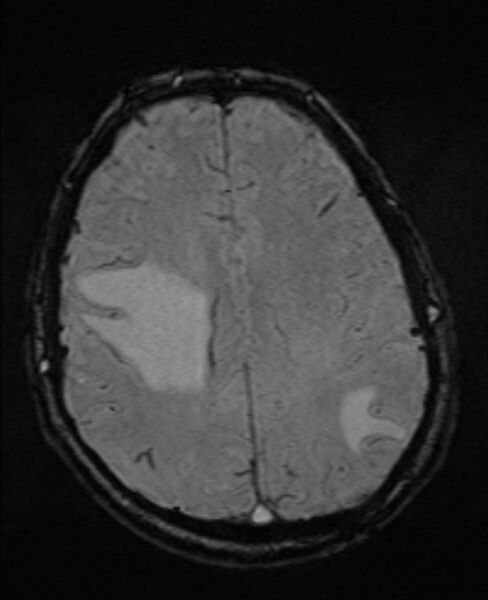 File:Brain metastases - lung cancer primary (Radiopaedia 75060-86115 Axial SWI 42).jpg