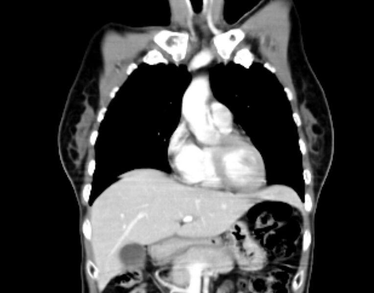 File:Brain metastasis as initial presentation of non-small cell lung cancer (Radiopaedia 65122-74127 C 9).jpg