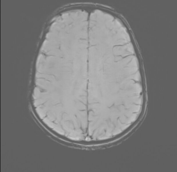 File:Brainstem glioma (Radiopaedia 70548-80674 Axial SWI 44).jpg