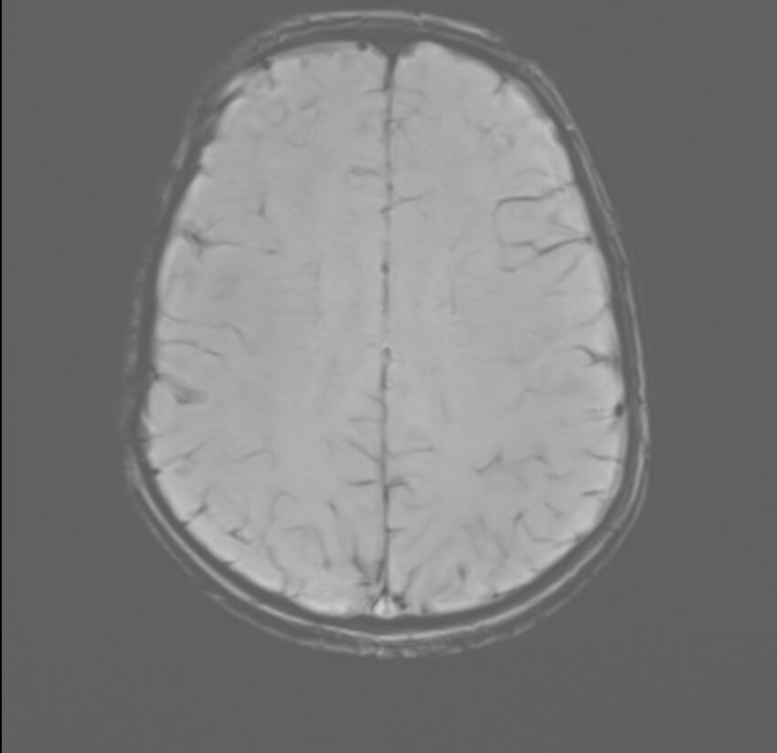 Brainstem glioma (Radiopaedia 70548-80674 Axial SWI 44).jpg