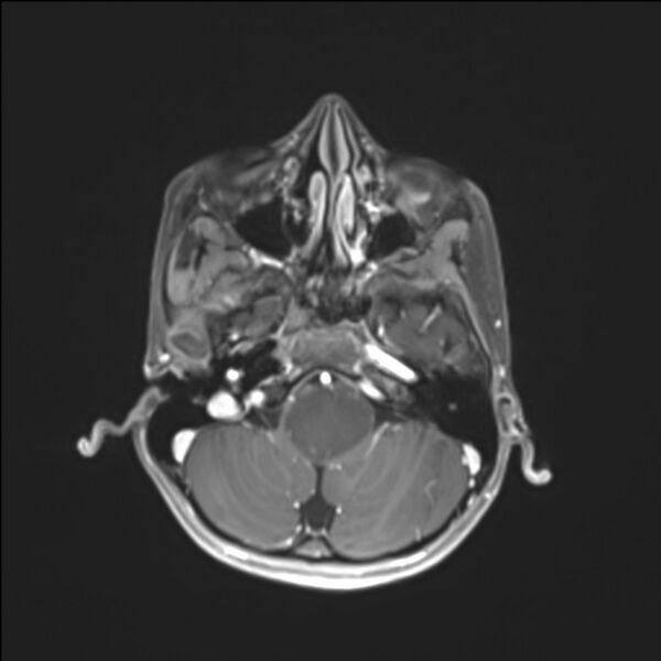 File:Brainstem glioma (Radiopaedia 70548-80674 Axial T1 C+ 36).jpg