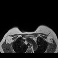Breast implants - MRI (Radiopaedia 26864-27035 Axial T1 45).jpg