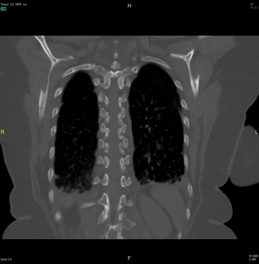 Breast primary with lung and bone metastases (Radiopaedia 40620-43228 bone window 60).jpg