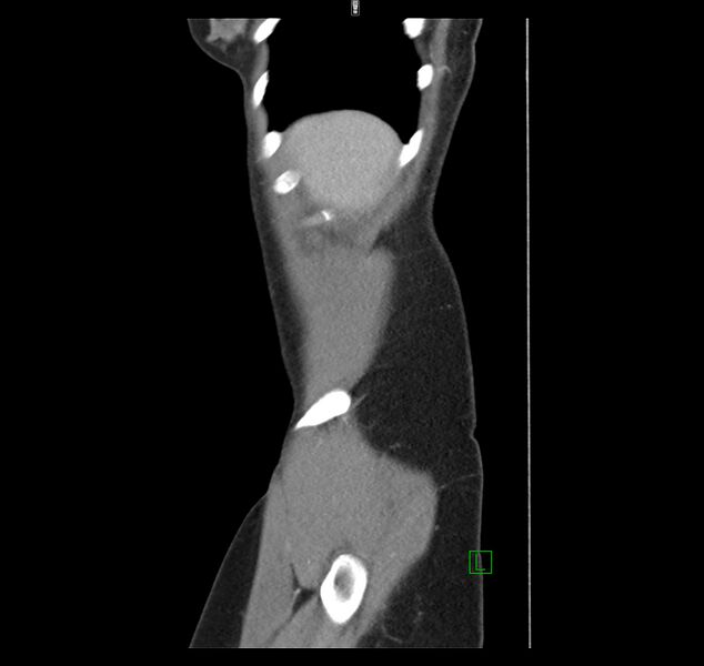 File:Broad ligament hernia (Radiopaedia 63260-71832 C 4).jpg