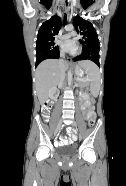 File:Bronchial carcinoid tumor (Radiopaedia 57187-64090 B 49).jpg