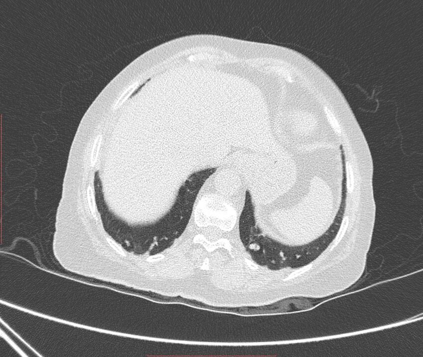 Bronchiectasis (Radiopaedia 72693-83293 Axial lung window 120).jpg