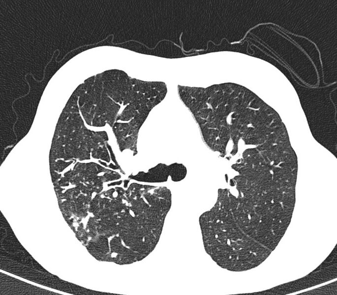 File:Bronchiolitis (Radiopaedia 24616-24887 Axial lung window 19).jpg