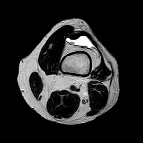 File:Bucket handle tear - medial meniscus (Radiopaedia 29250-29664 Axial T2 20).jpg