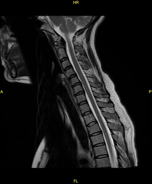 File:C5 nerve sheath tumor (Radiopaedia 85777-101596 Sagittal T2 10).jpg